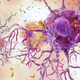 Inflamación cerebral por la enfermedad de Alzheimer